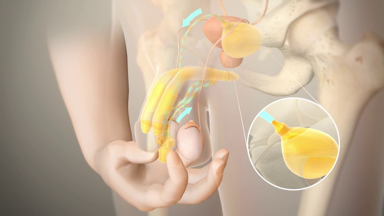 Penile length preservation in penile prosthesis placement: tips & tricks