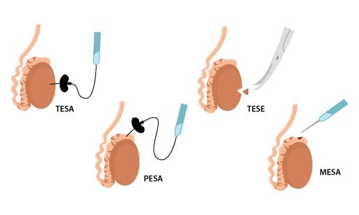 Azoospermia
