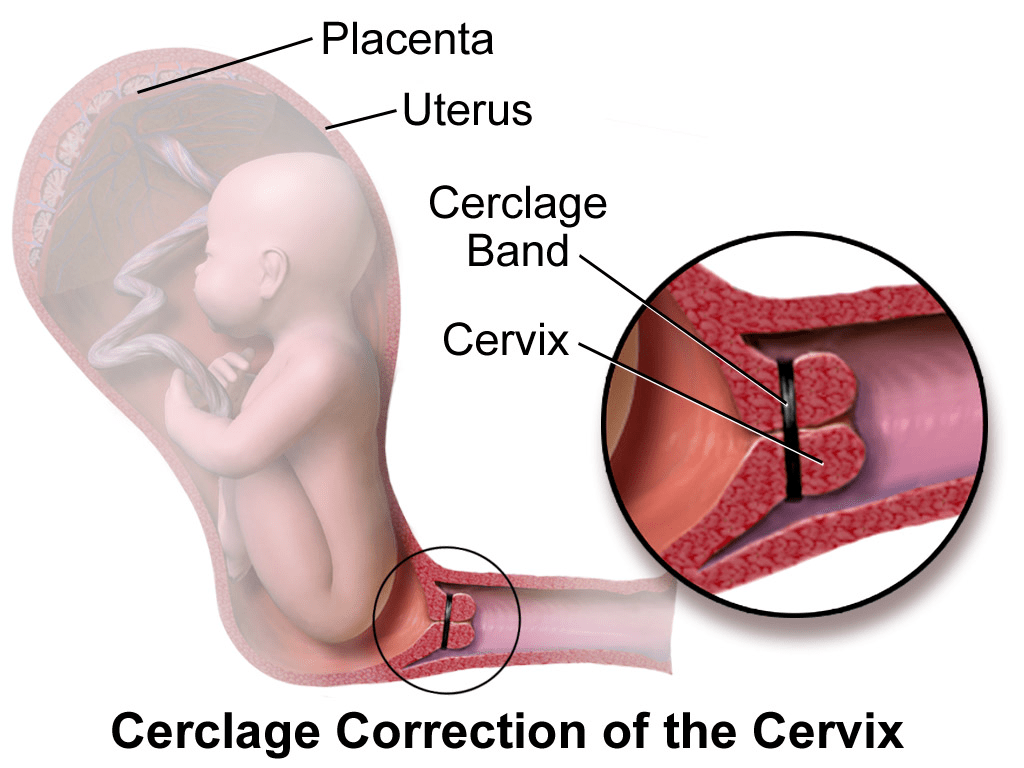 Cervical cerclage