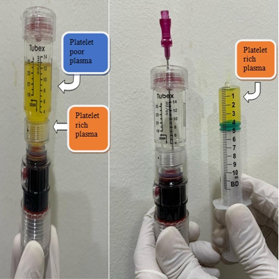 Autologous Platelet-Rich Plasma Penile Injection After Failed Oral Medical Management of Erectile Dysfunction