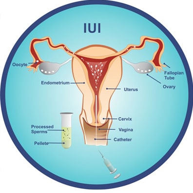 IUI Treatment in New BEL Road, Bangalore