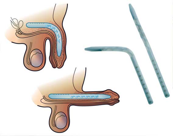 Penile Implant Surgery Cost in Bangalore