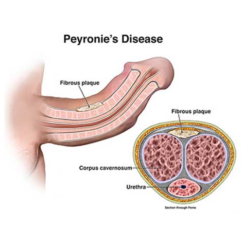 Peyronies Disease Treatment Cost in Bangalore