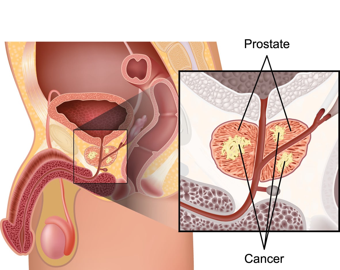 Prostate Health and Cancer Screening
