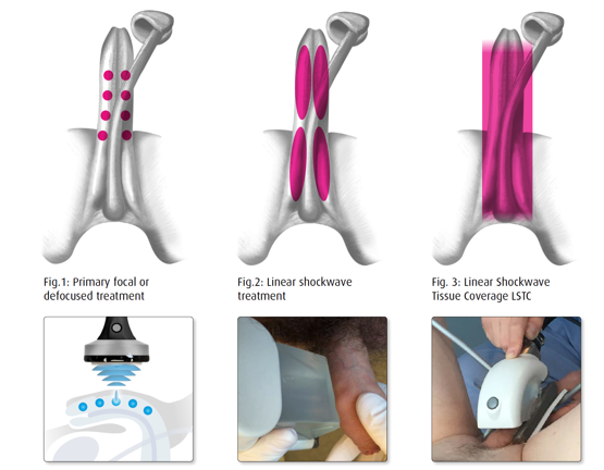 Shockwave Therapy