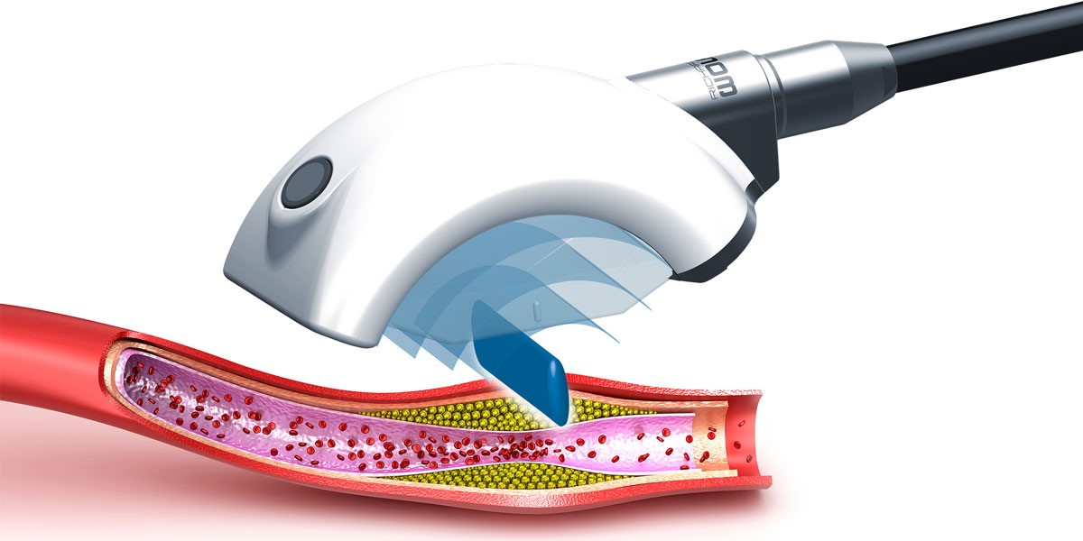 Shockwave Therapy