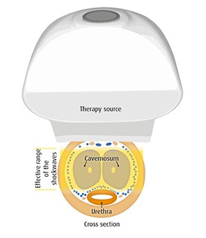 Shockwave Therapy