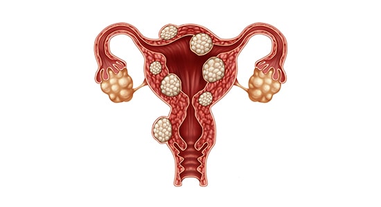 Fibroid uterus